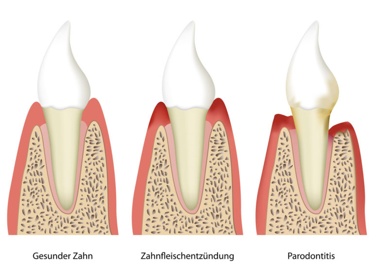 Zahnzentrum Ennigerloh - Fachtthema Parodontitis - Schaubild Zahnfleischentzündung Parotontitis